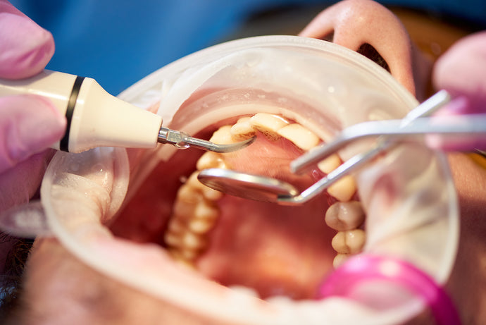 Tartar Causes